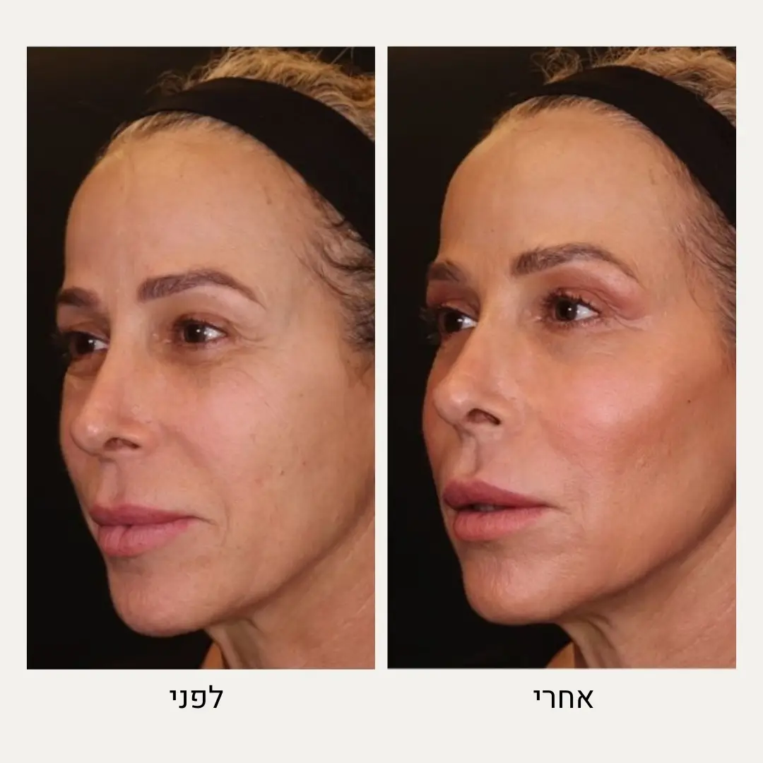 תמונות לפני ואחרי עצמות לחיים - ד״ר אלה אגוזי