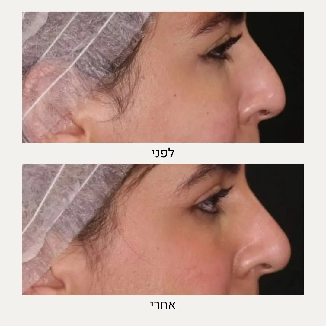 תמונות לפני ואחרי פיסול אף - ד״ר אלה אגוזי