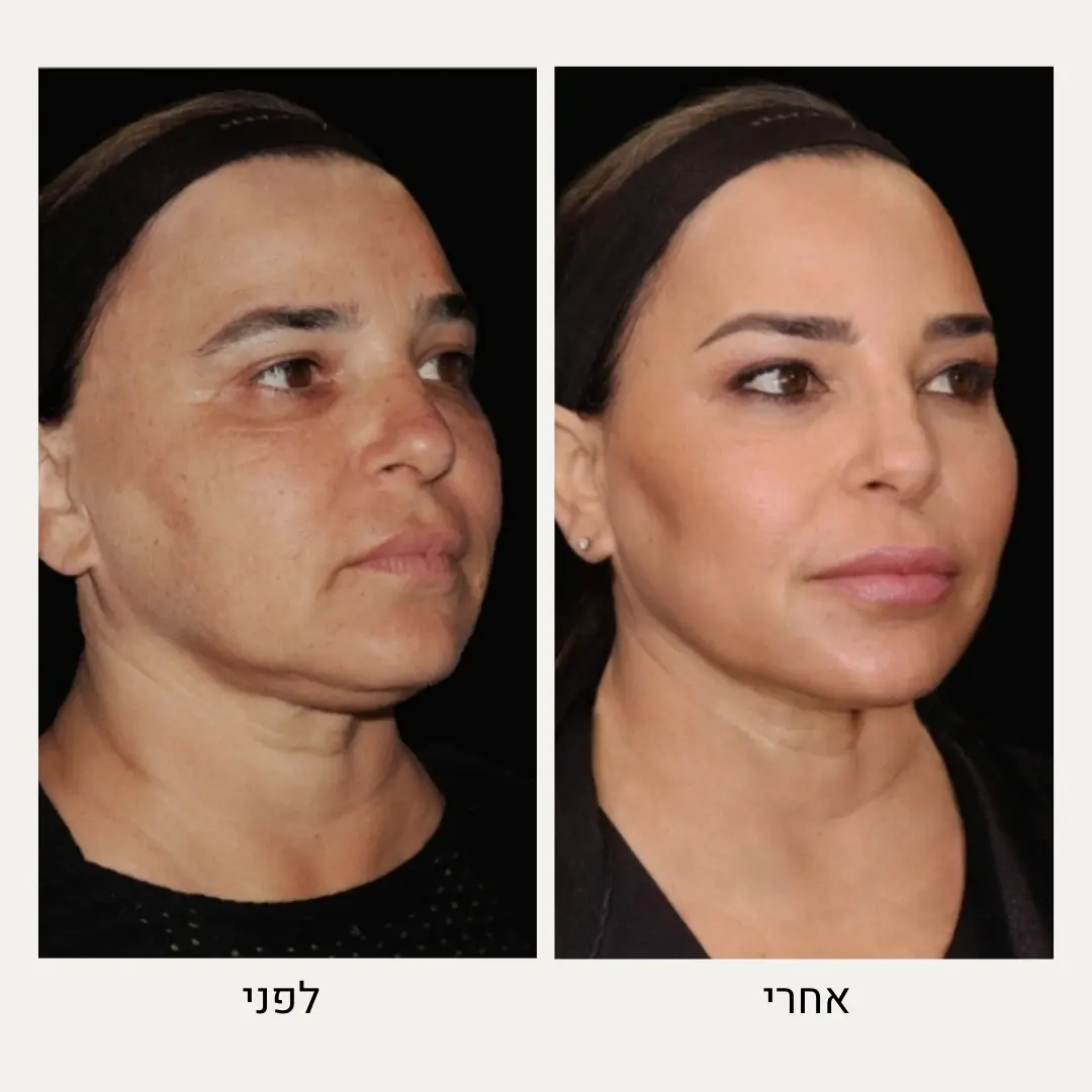 תמונות לפני ואחרי סקולפטרה - ד״ר אלה אגוזי