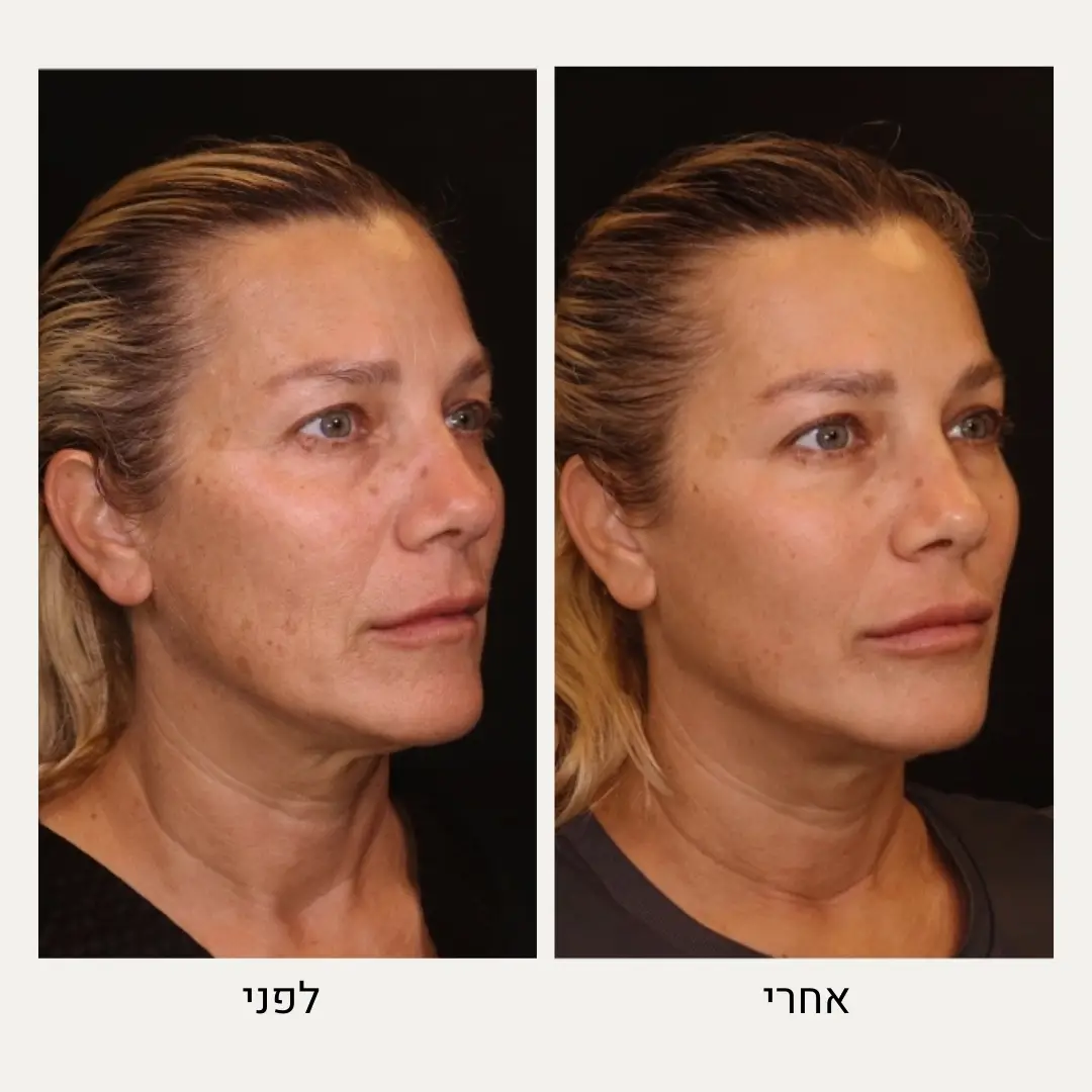 תמונות לפני ואחרי רדיאס - ד״ר אלה אגוזי