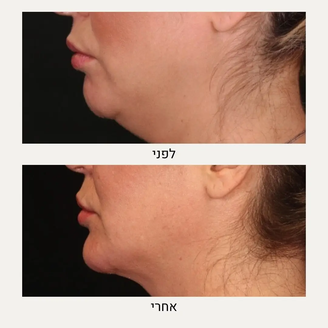 תמונות לפני ואחרי המסת שומן בסנטר - ד״ר אלה אגוזי