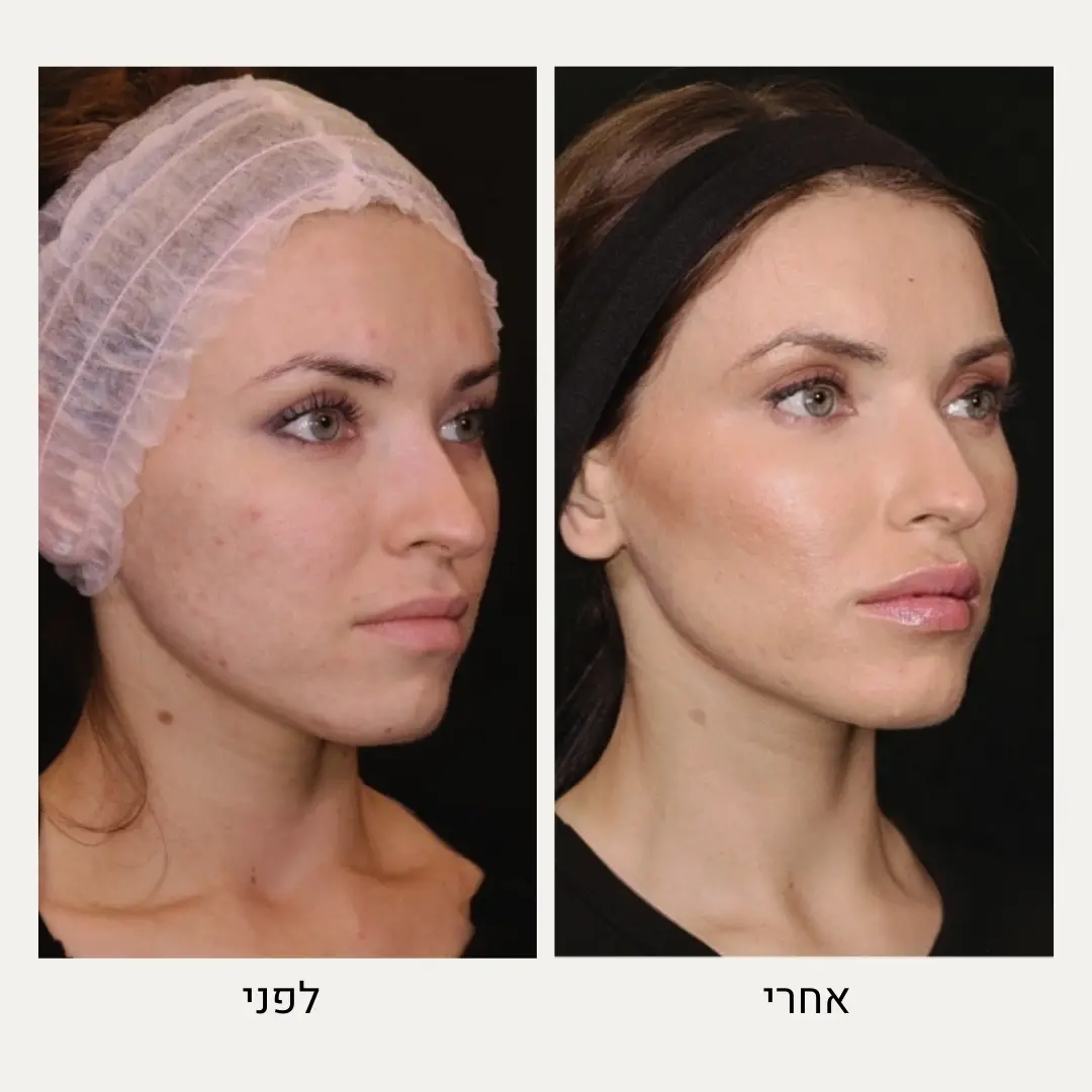 תמונות לפני ואחרי צלקות אקנה - ד״ר אלה אגוזי