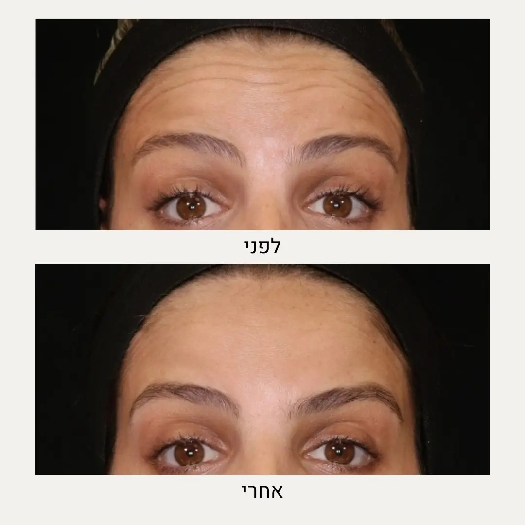 תמונות לפני ואחרי בוטוקס מצח - ד״ר אלה אגוזי