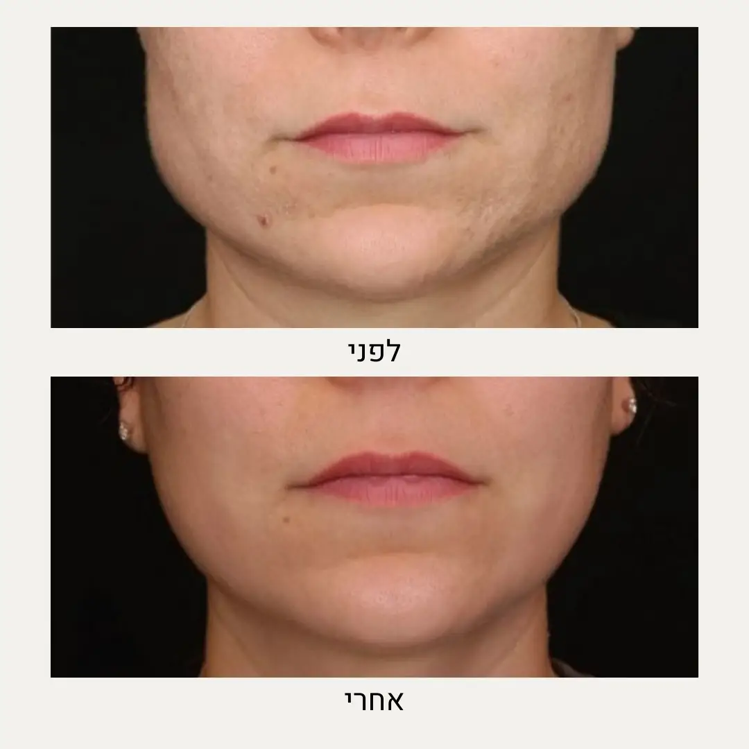 תמונות לפני ואחרי בוטוקס - ד״ר אלה אגוזי