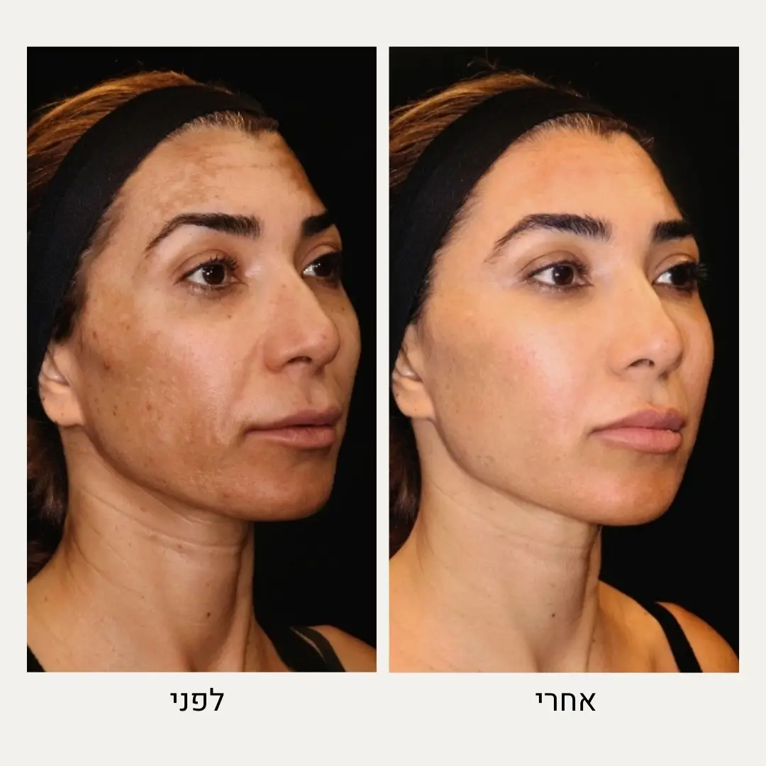 תמונות לפני ואחרי הסרת פיגמנטציה בלייזר - ד״ר אלה אגוזי