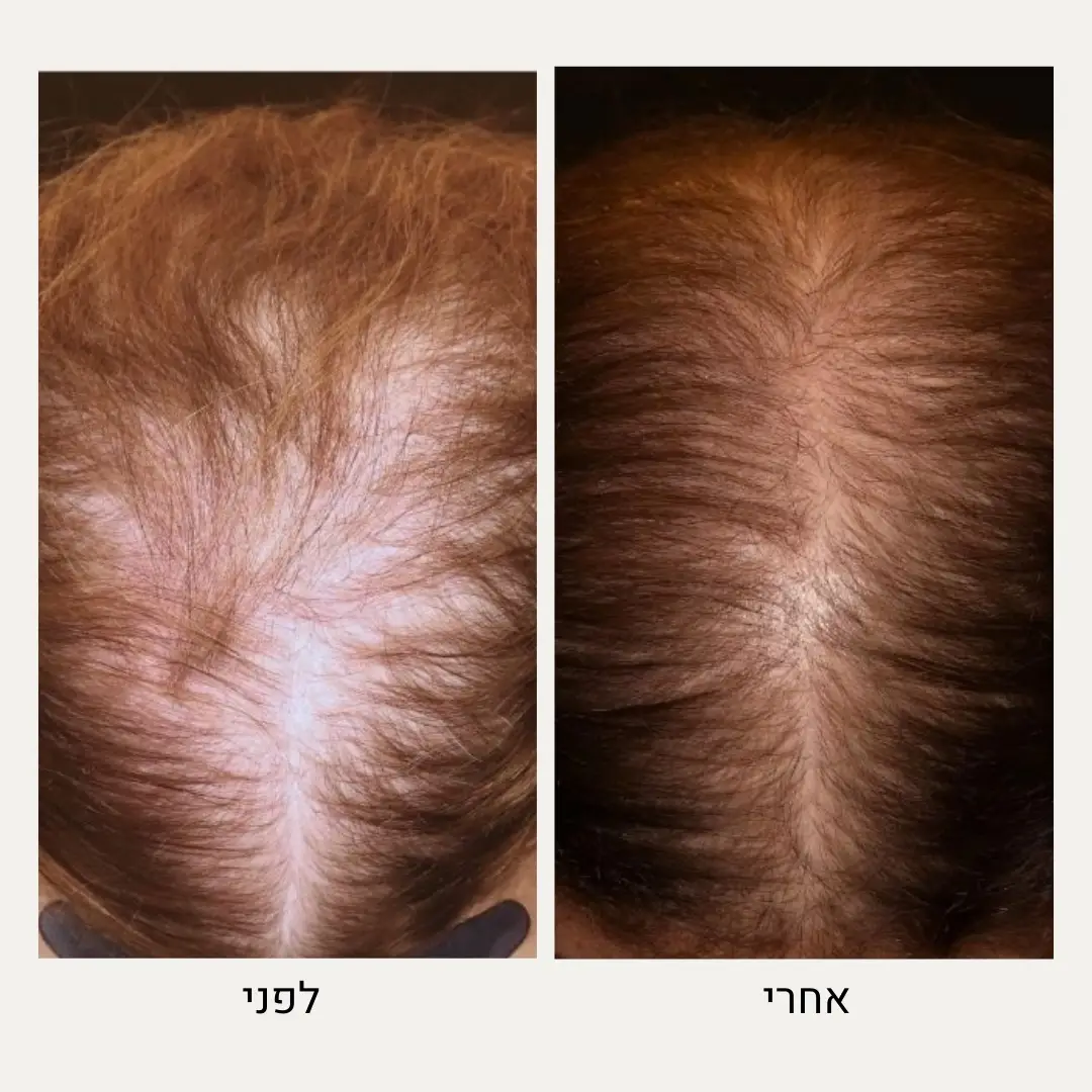 תמונות לפני ואחרי prp - ד״ר אלה אגוזי