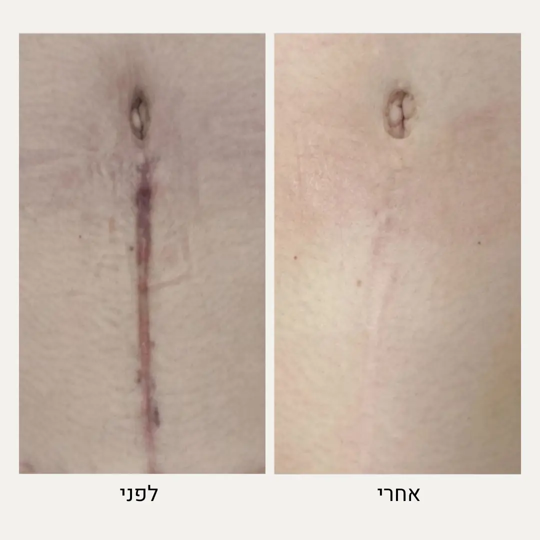 תמונות לפני ואחרי הסרת צלקות בלייזר - ד״ר אלה אגוזי