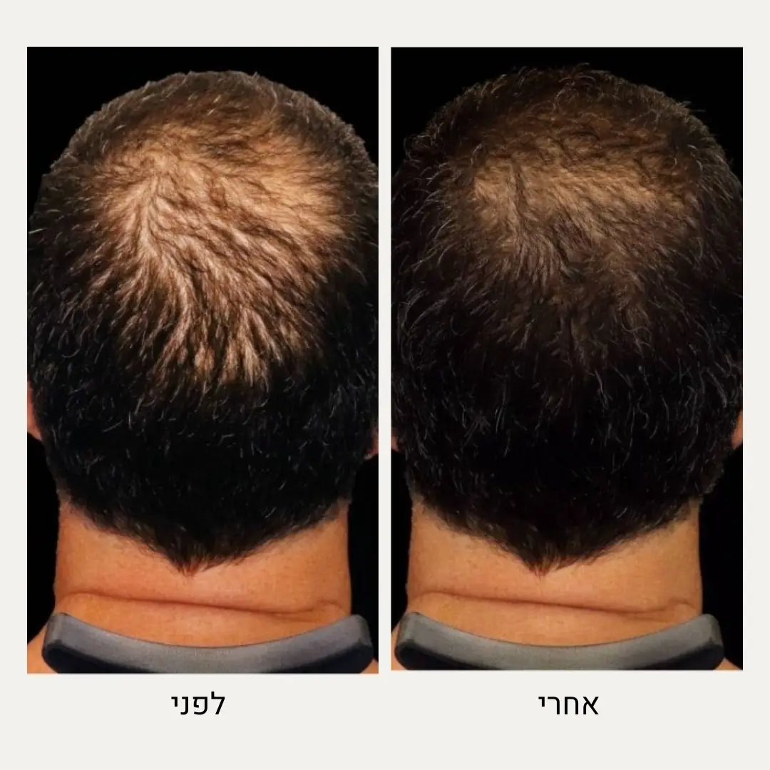 תמונות לפני ואחרי רגינרה - ד״ר אלה אגוזי