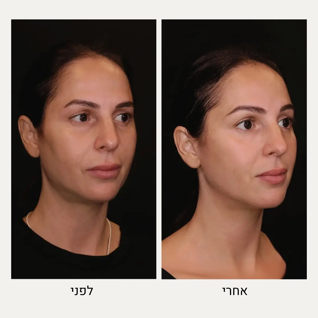 תמונות לפני ואחרי פיסול פנים - ד״ר אלה אגוזי