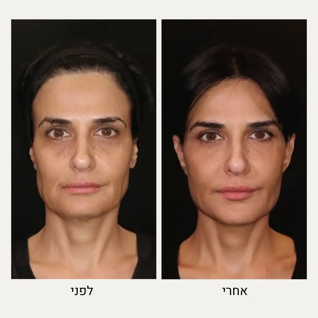 תמונות לפני ואחרי מזותרפיה - ד״ר אלה אגוזי