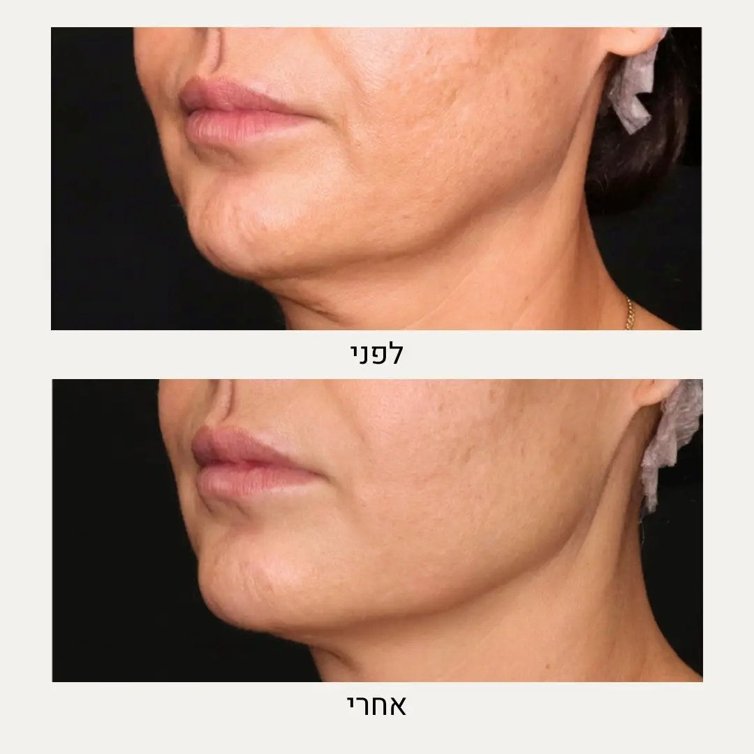 תמונות לפני ואחרי קו לסת - ד״ר אלה אגוזי