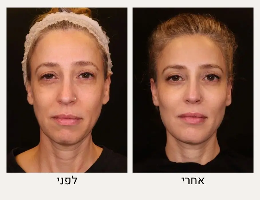 מיצוק עור הפנים לפני ואחרי - ד״ר אלה אגוזי