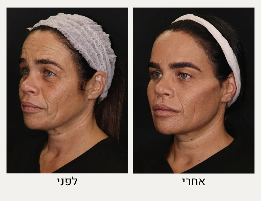 לפני ואחרי שיפור מרקם עור הפנים - ד