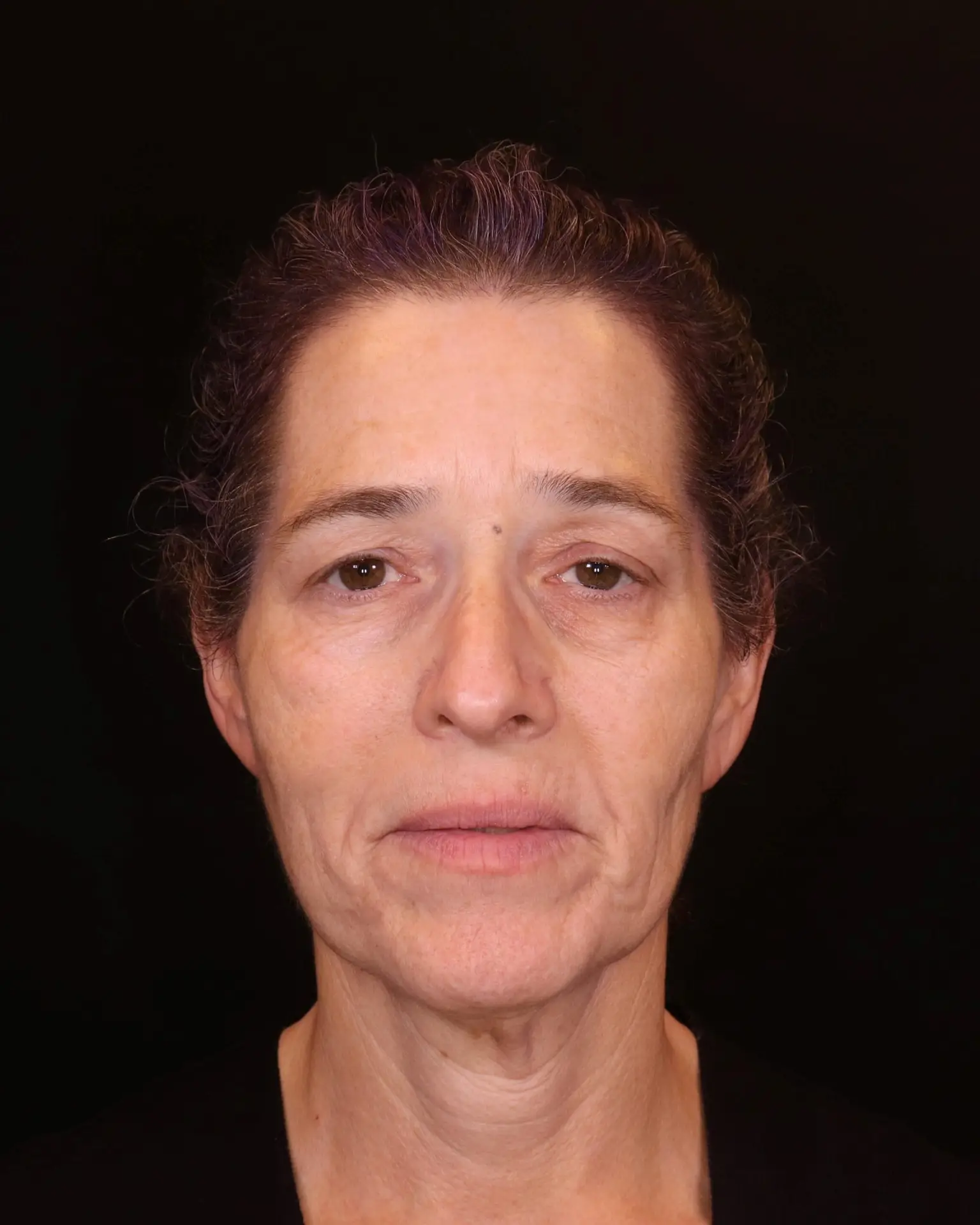 ככה זה התחיל: מבט מקרוב על עור הפנים לפני המהפך בשיטה הייחודית של ד"ר אלה אגוזיתמונה אחרי טיפול בשיטת שלוש השכבות - ד"ר אלה אגוזי