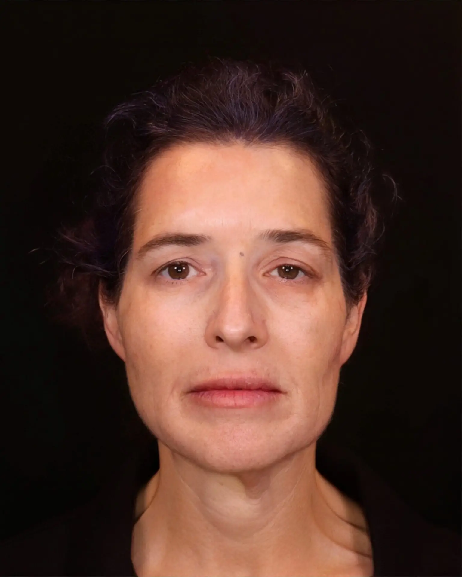 לפתוח דף חדש: עור קורן וצעיר יותר בסיום הטיפול בשיטת 3 השכבות אצל ד"ר אלה אגוז