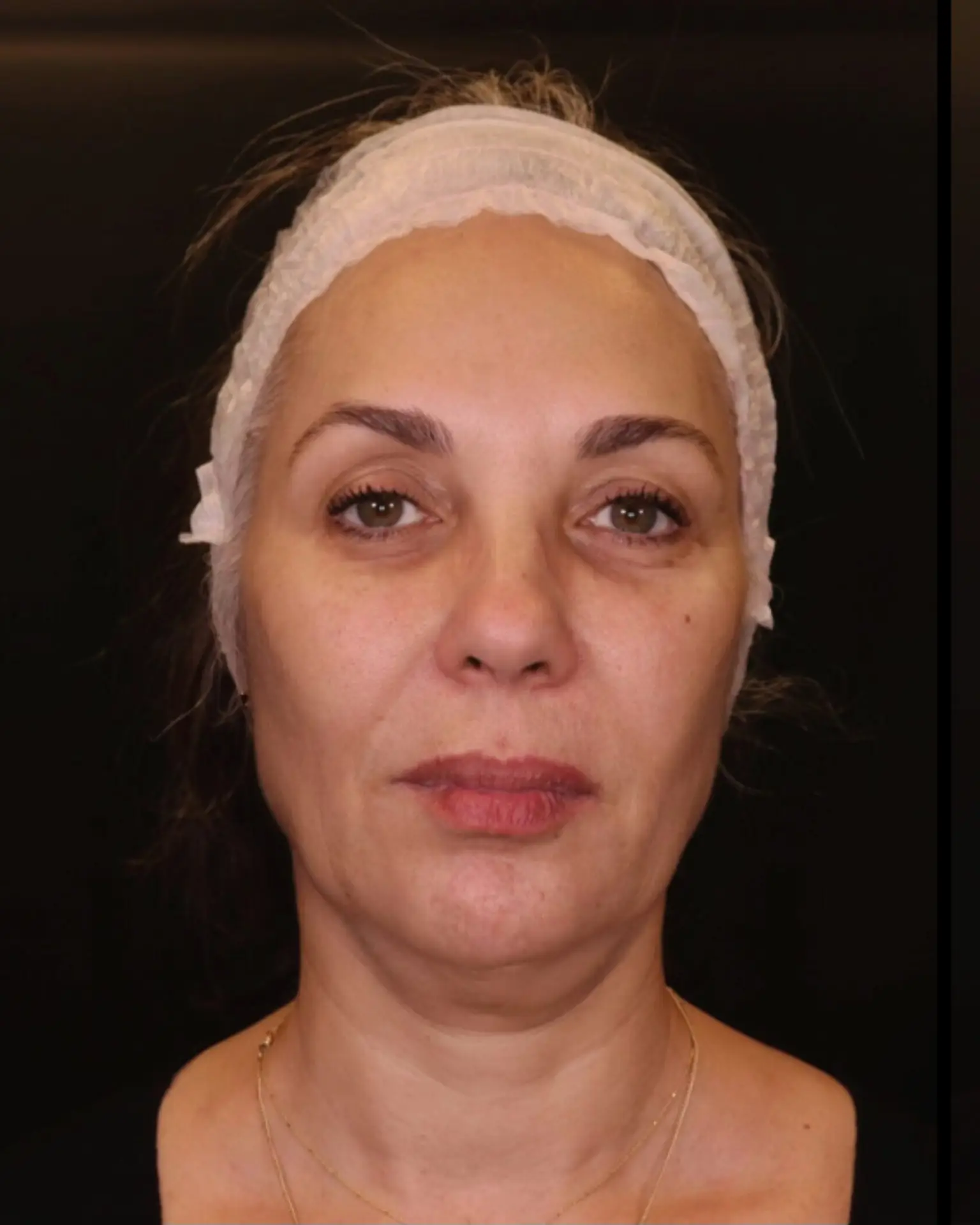 שלב האבחון: מראה הפנים לפני תחילת הטיפול בשיטת 3 השכבות של ד"ר אלה אגוזי