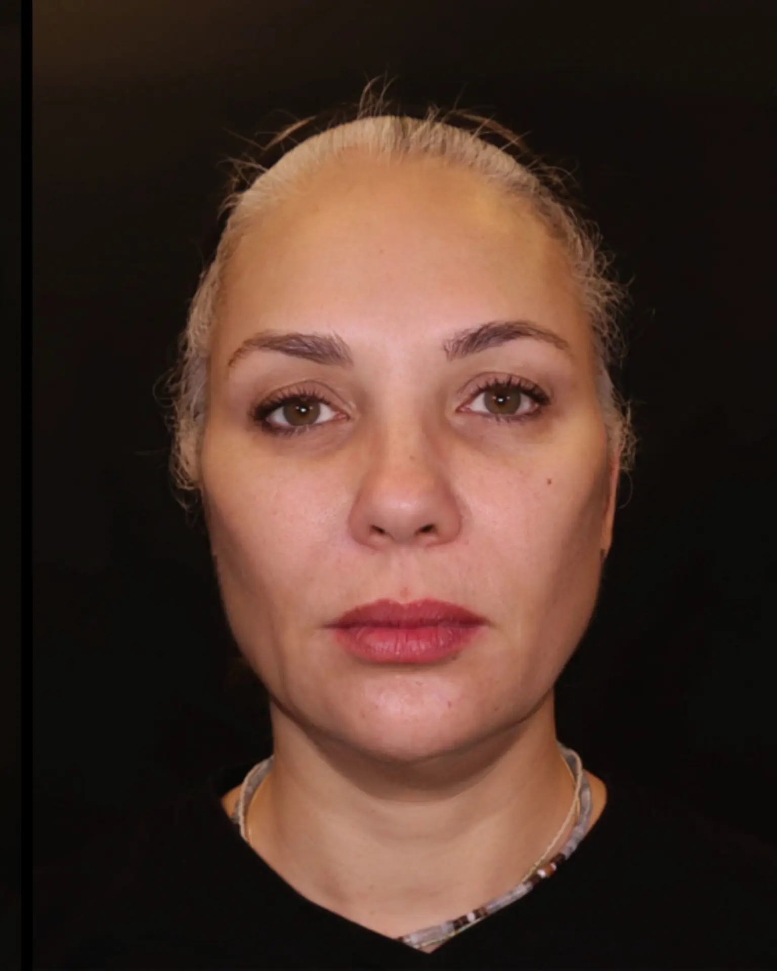 התוצאה הסופית: מראה מתוח, רענן וטבעי לאחר יישום שיטת שלוש השכבות מאת ד"ר אלה אגוזי.