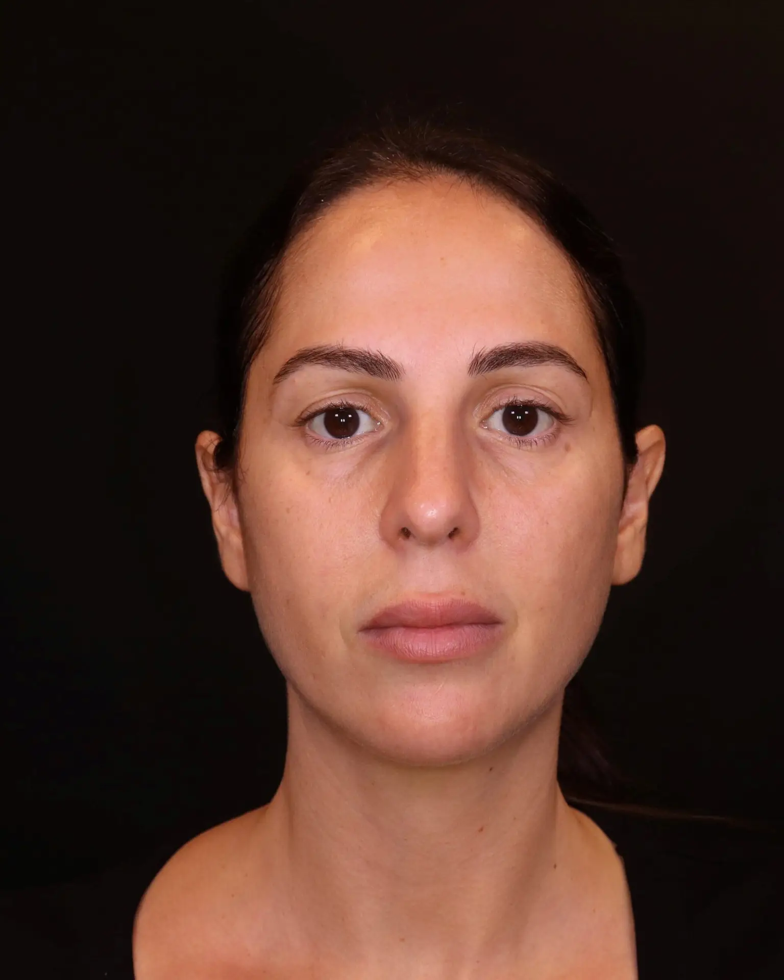 תמונה לפני טיפול בשיטת שלוש השכבות - ד"ר אלה אגוזי