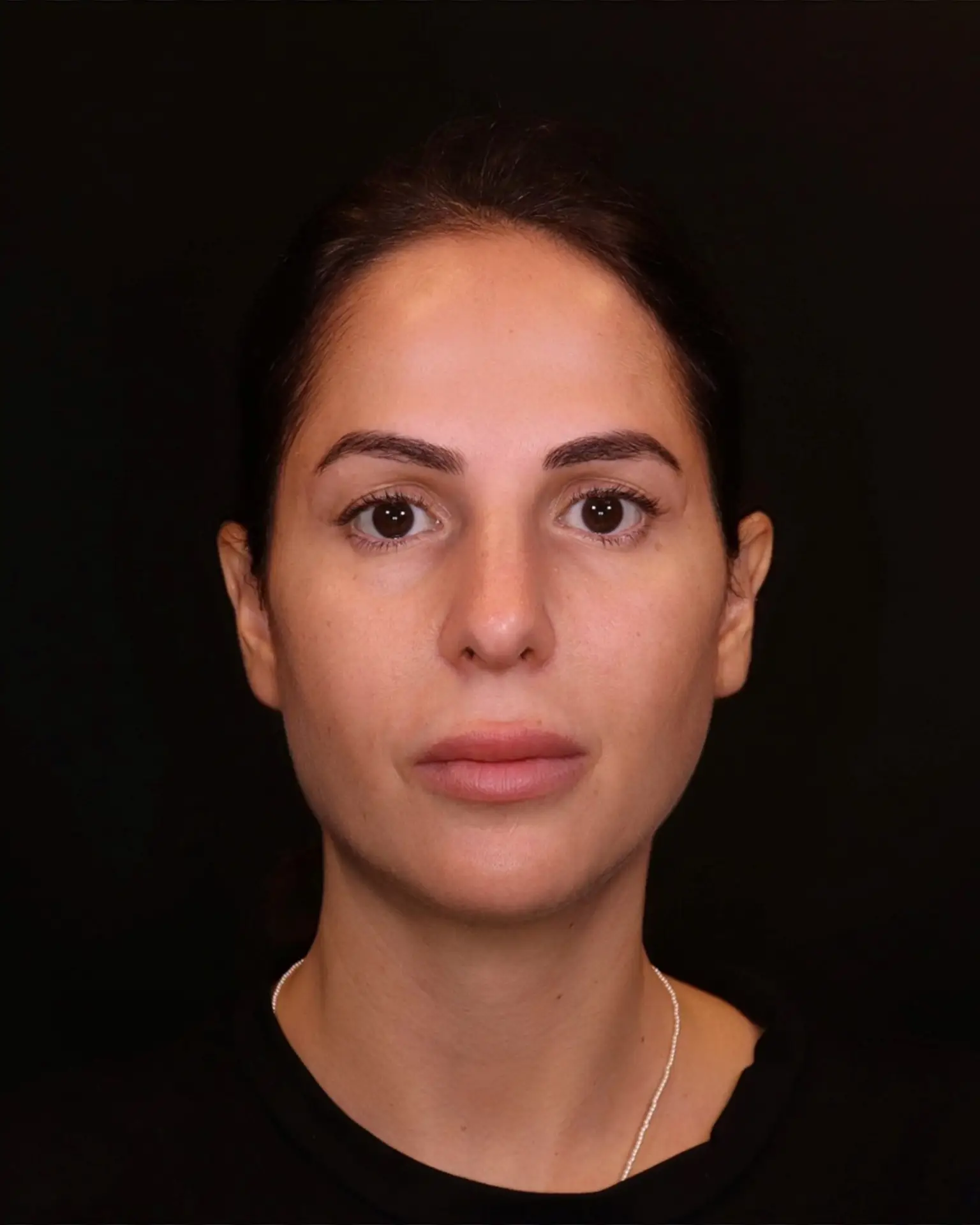 תמונה אחרי טיפול בשיטת שלוש השכבות - ד"ר אלה אגוזי