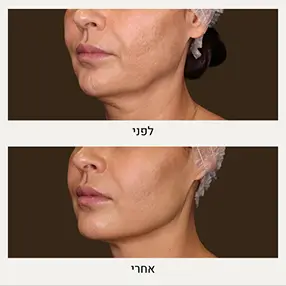 תמונות של קו לסת לפני אחרי - המרכז לרפואת עור ואסתטיקה, ד"ר אלה אגוזי