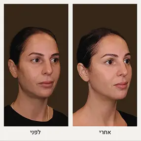 תמונות של פיסול פנים לפני ואחרי - המרכז לרפואת עור ואסתטיקה, ד"ר אלה אגוזי