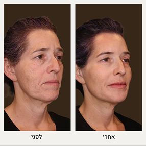 תמונות של מתיחת פנים לפני אחרי - המרכז לרפואת עור ואסתטיקה, ד"ר אלה אגוזי