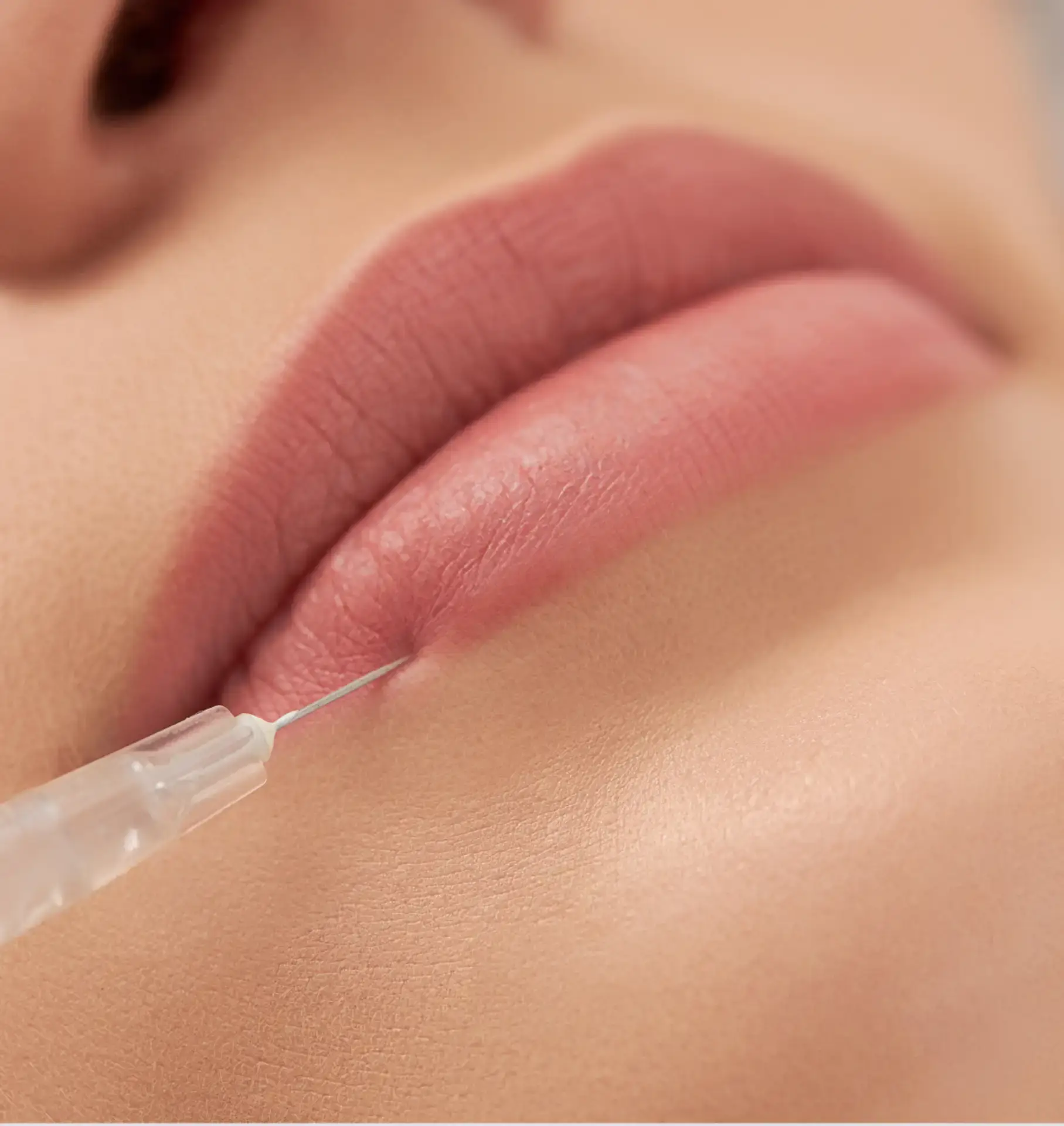 עיצוב שפתיים וטיפול בקפל המריונטה - ד"ר אלה אגוזי